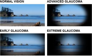 glaucoma vision