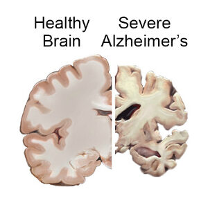 Healthy Brain vs Severe Alzheimers